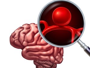 Brain Aneurysms