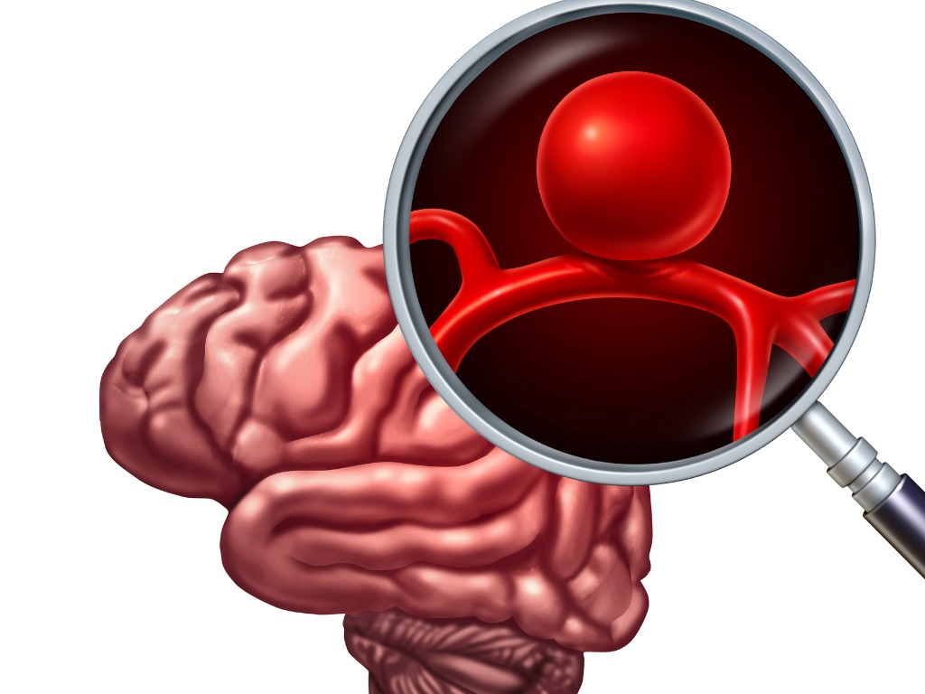 Brain Aneurysms