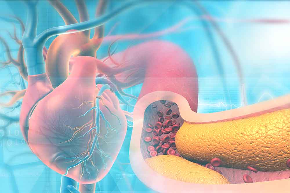 Screening---Coronary-CTA